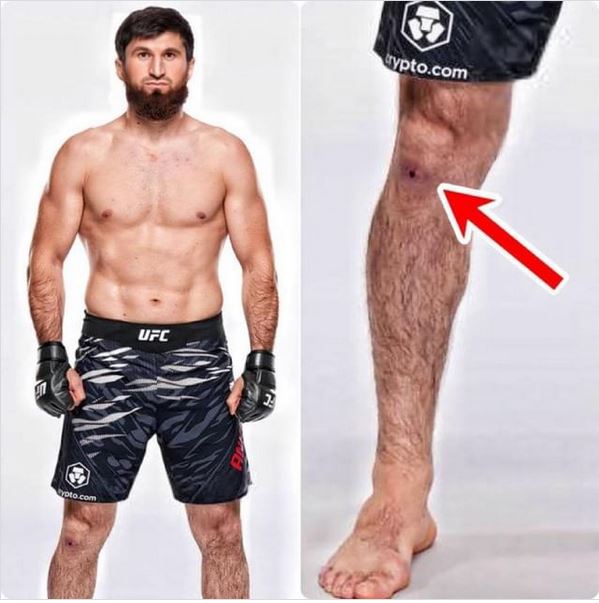 Dramatic Staph Infection Rumors Swirl Around Magomed Ankalaev Ahead of Epic UFC 308 Showdown!